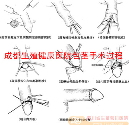 成都生殖健康医院包茎手术过程