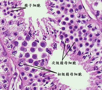 梗阻性无精子症