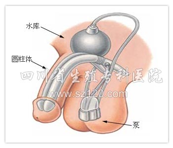 阴茎假体植入术图谱_男性图库_文字版_四川省生殖健康研究中心附属